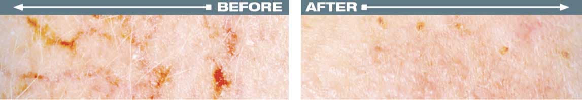Before and after Vasculyse treatment