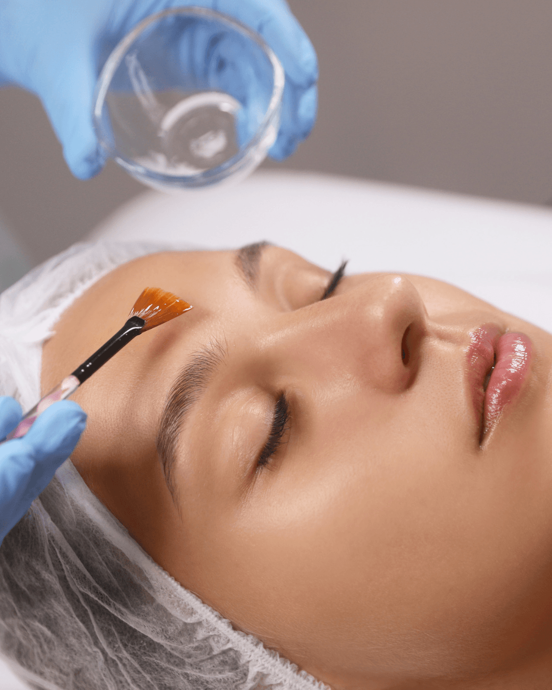 Chemical peels