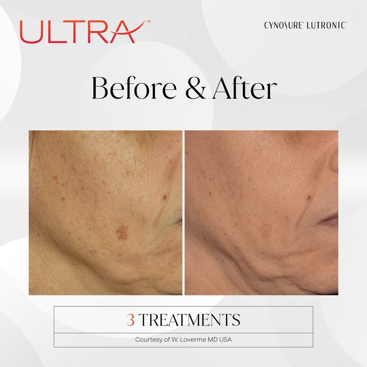 LaseMD Ultra before and after — facial pigmentation and sun damage, after 3 treatments