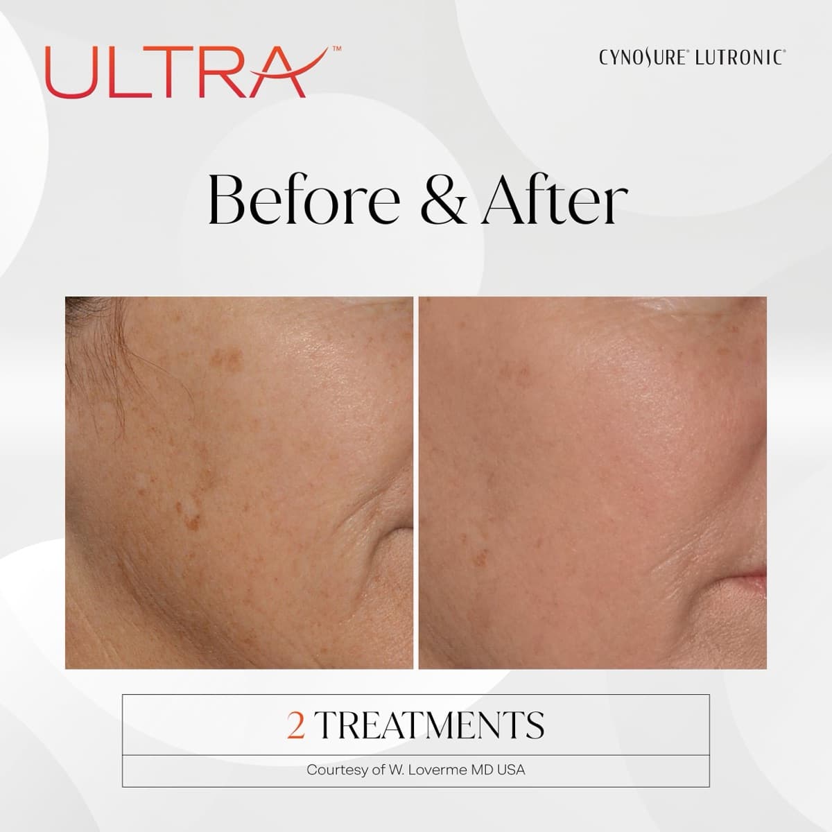 LaseMD Ultra before and after — facial pigmentation, after 2 treatments