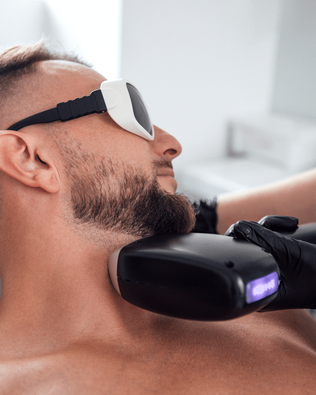 Six-session laser hair reduction