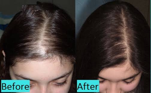 Scalp microneedling — female patient